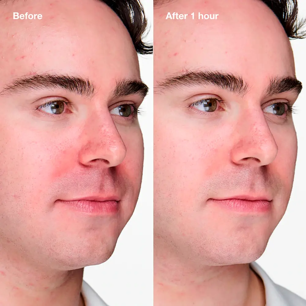 <span class="notranslate">CLINIQUE ANTI-BLEMISH SOLUTIONS</span> CLINICAL advanced anti-blemish gel 20 ml